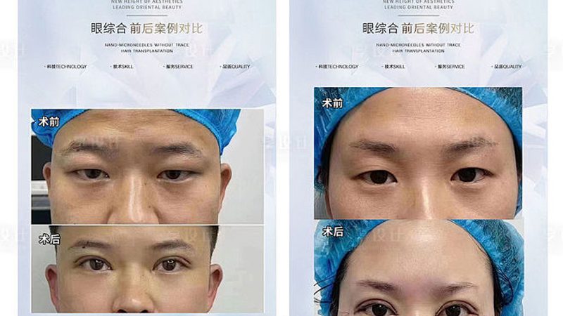 隆鼻假体价格背后的隐形账单