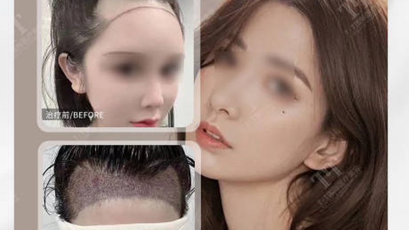 小标题：术后恢复概述
