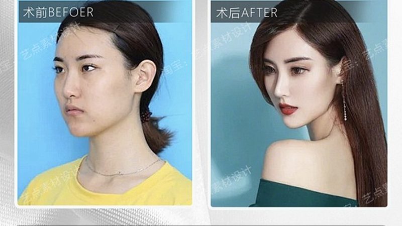 激光去红血丝与护肤品：如何选择更适合自己的方案