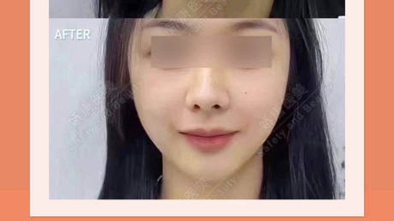 玻尿酸面膜敷脸后发红？揭秘原因与应对措施