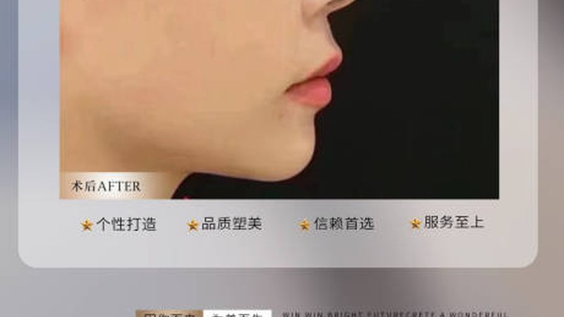 小标题：双眼皮手术，安全与美丽并行