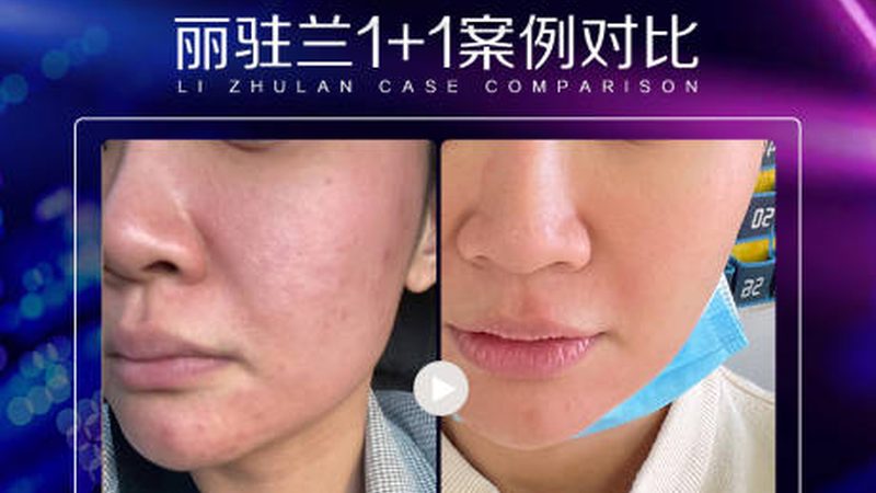 光子嫩肤后反黑现象，了解真相才能安心变美