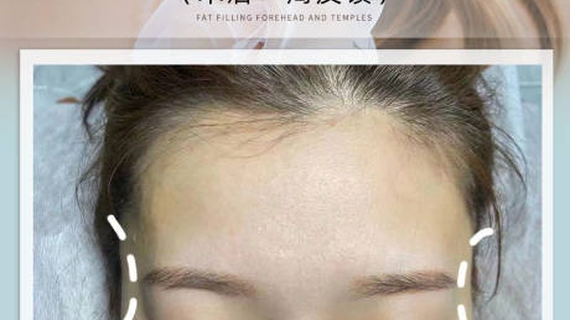 揭秘激光美容仪器：十大品牌背后的技术秘密