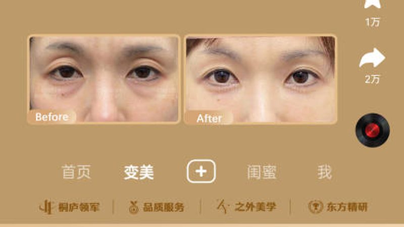 全切双眼皮与埋线双眼皮：材质大揭秘