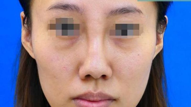 激光美容祛斑仪器型号参数大全